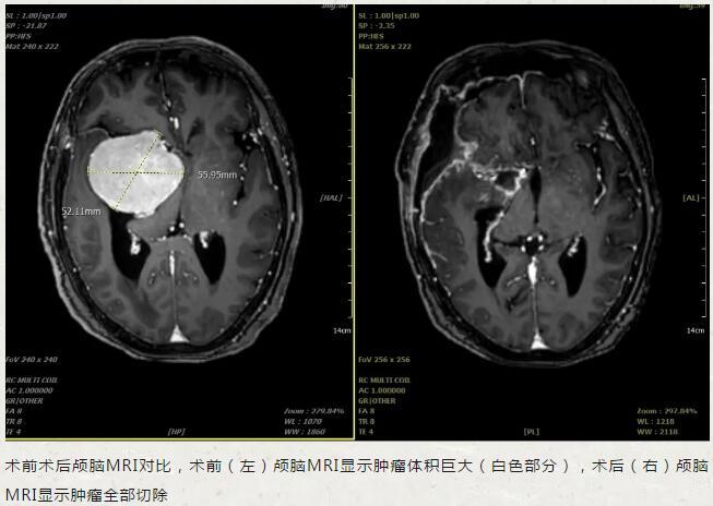 醫生8小時成功切除古稀老人顱底6釐米巨大腦膜瘤