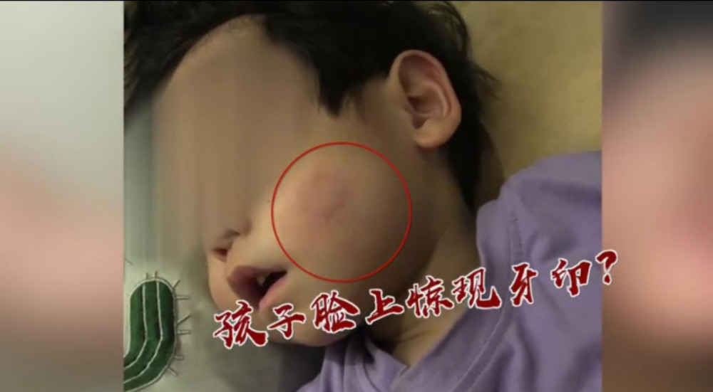 小孩中午睡觉的时候,有一个同班小男孩,很调皮地在你的孩子脸上咬了一