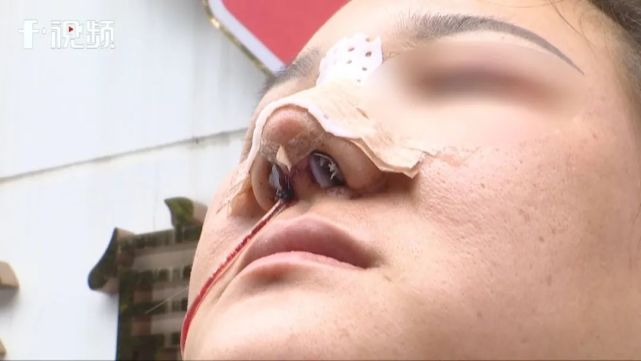 女子隆鼻后鼻子流脓发臭,记者采访遭粗暴阻挠:摄像机被摔,话筒等设备