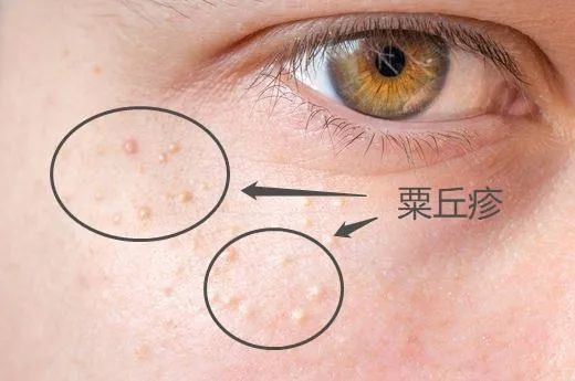 长"脂肪粒" ,不是眼霜的错!|每日新get√_腾讯新闻
