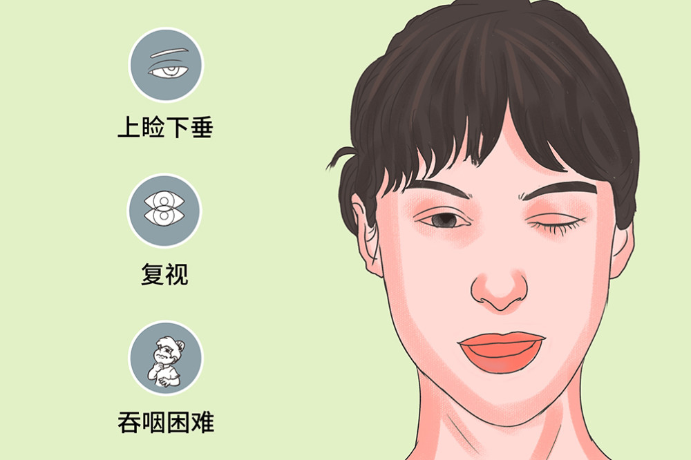 全身型重症肌无力患者经休息和胆碱酯酶抑制剂治疗后症状减轻