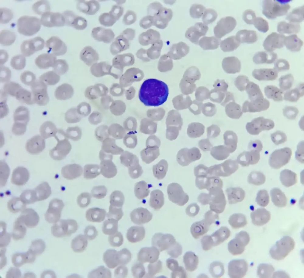 关于异型异常淋巴细胞几点心得体会