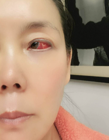 歌后辛晓琪身体亮红灯眼睛爆血太可怕59岁仍未婚无人陪