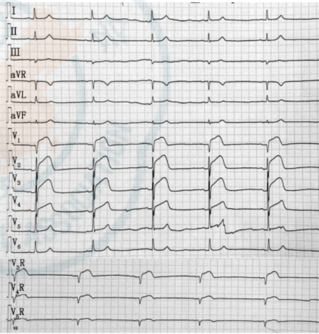 病例孤立性右心室梗死致胸前導聯st段抬高