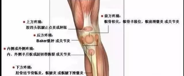 1看就懂的膝关节周围疼痛鉴别诊断 腾讯新闻