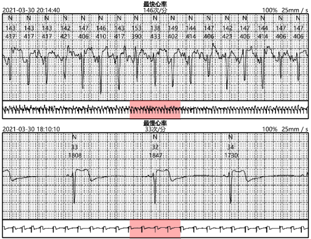 2,房性早搏15次;平均心率为65次/分,最快心率是146次/分,发生于2021
