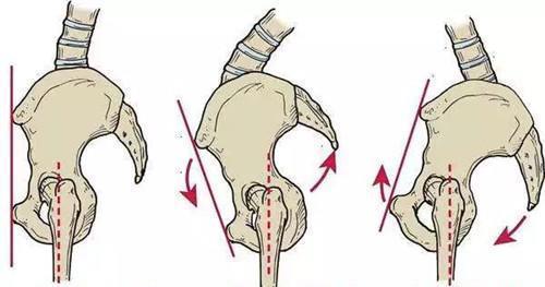 迪麗熱巴翹臀作假骨盆前傾後傾那該如何改善呢
