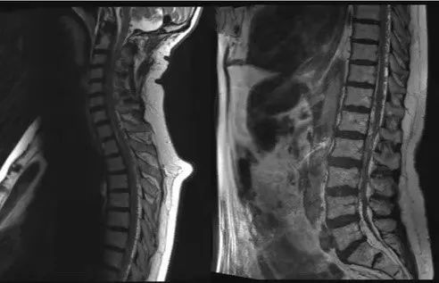 苏灿定睛一看,发现患者的脊髓mri有典型的虫蚀样血管流空影(见下图)