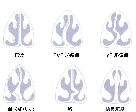 鼻中隔是位于双侧鼻腔之间的"隔断",由骨和软骨构成,把鼻腔分成左右