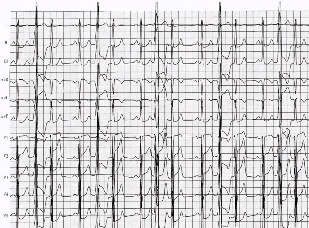关于室性早搏很全面的总结 医生护士想了解的知识都在这里了 腾讯新闻