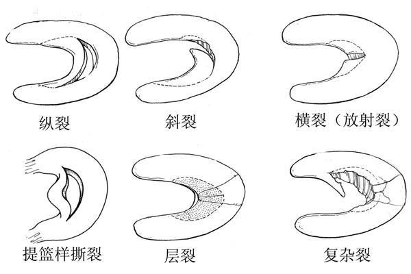 半月裂孔解剖图图片