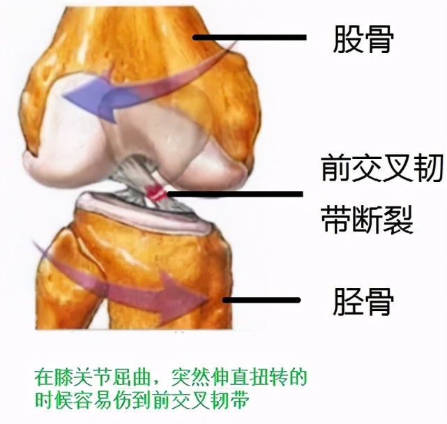 膝關節扭傷後一直疼痛腫脹警惕膝關節韌帶損傷