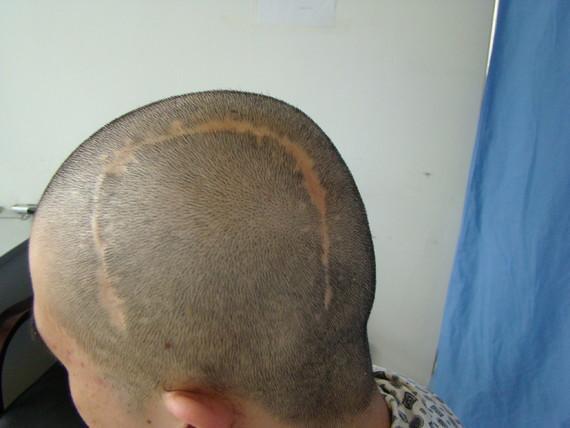 北京熙朵植发专家表示,疤痕类的脱发是可以通过疤痕移植改善的.