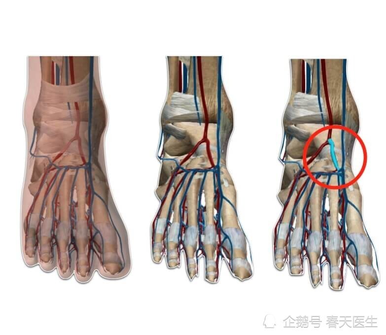 胫后动脉外侧跗骨动脉仪器检查踝肱指数(abi,又称作动脉分段血流及