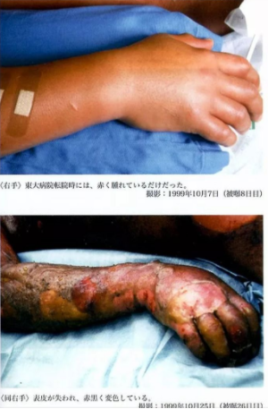 遭核辐射后83天,他成了"世界上死的最惨的人"