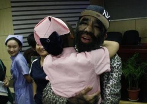 全身长满毛的毛孩于震寰曾被无数人嘲讽现生活令人羡慕