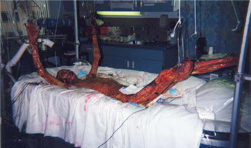 日本核辐射感染者被医生强行救治83天每天目睹自己皮肤腐烂