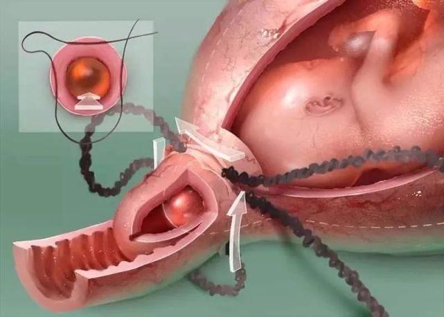 宫颈环扎后要卧床多久?|宫颈环扎|宫缩|宫颈|保胎