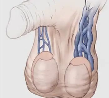 这种精索静脉曲张一般会导致不育,当蛋蛋有疼痛感,潮湿下垂等症状时要