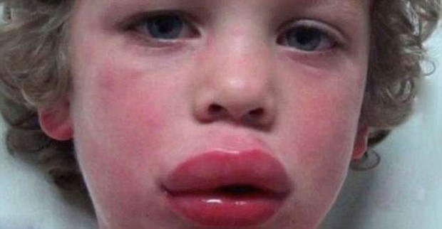 就像之前有位男孩因为偷吃吃了葡萄出现了过敏反应,嘴唇肿得成了"香肠