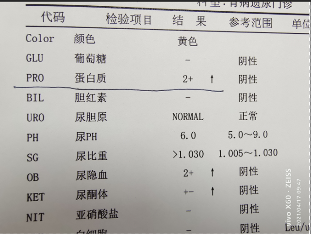 仔细看一下孩子的化验结果:还真是有尿蛋白!