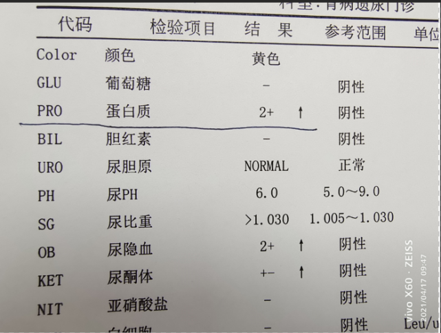 尿常规化验单儿童图片