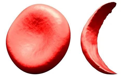 新型口服药物ftx-6058有望用于治疗镰状细胞病|镰状细胞病|血红蛋白