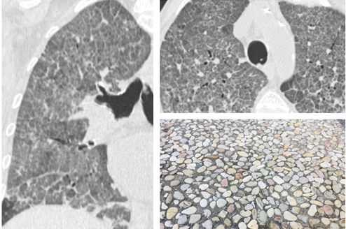 可見雙肺瀰漫性毛玻璃密度影伴網狀改變