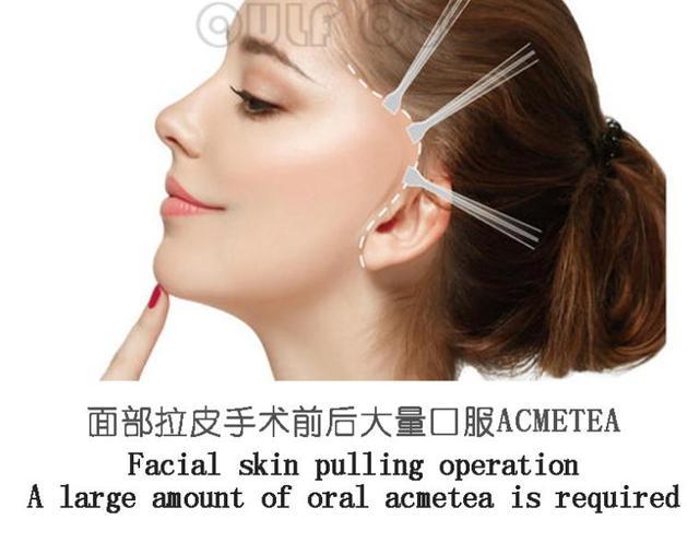 面部线雕术多久消肿手术脸部拉皮可以维持多久