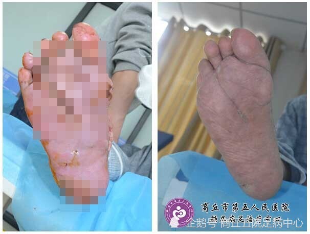 糖尿病老烂脚能不截肢治疗好吗