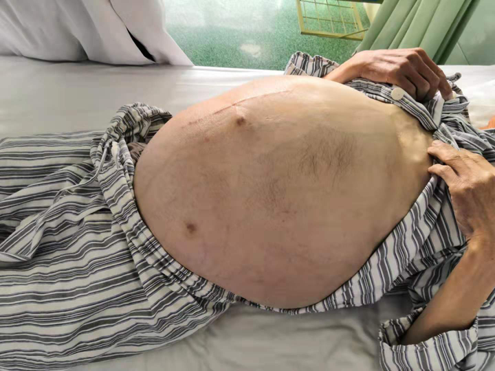 腹腔热灌注化疗技术 Hipec 为癌性腹水患者带来希望 腾讯新闻