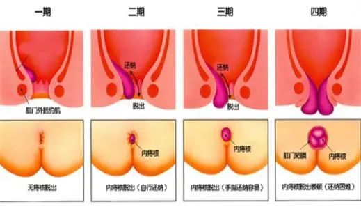 痔疮肉球严重吗严重痔疮症状有哪些这5个症状说明痔疮很严重