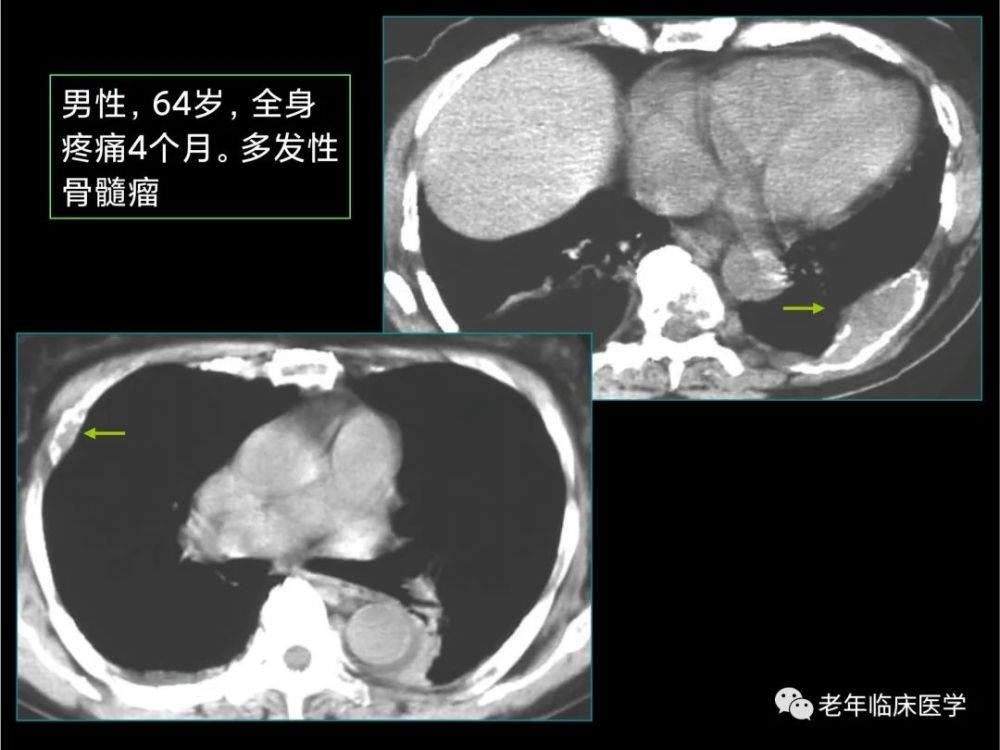 珍藏版ct系列之七肺其他惡性腫瘤