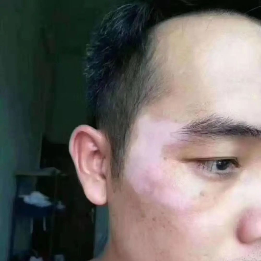 全国各地皮肤病患者数量激增,但由于大部分患者没有好的治疗方法,长期