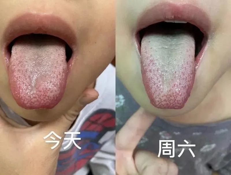 小孩大便幹黏小便黃氣味重溼熱質飲食清單請收好