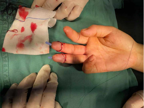 30岁女子做饭砍骨头不慎砍断两手指,紧急再植手术终于救活!