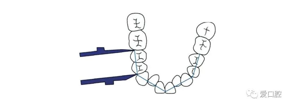 正畸临床模型牙齿拥挤度的测量方法