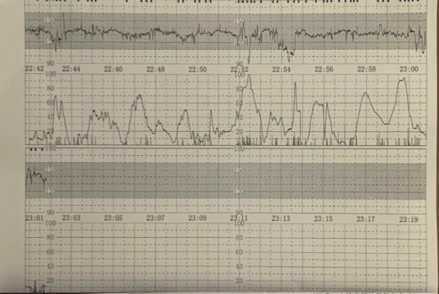 02:38 胎心监护图的基线在 170bpm 左右伴下降幅度非常大的变异减速00
