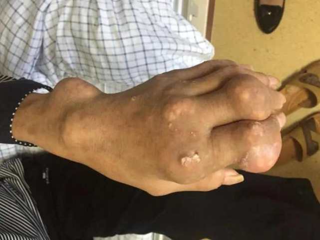 但因痛风反复发作,他的多处关节出现痛风石,有些实在没地方长的痛风石