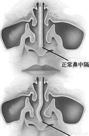 體檢中發現鼻中隔偏曲我需要動手術嗎