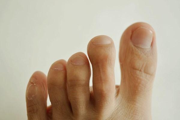 脚趾就算是最容易被人们忽略的一个部位,但是洽洽肺癌出现的前期征兆