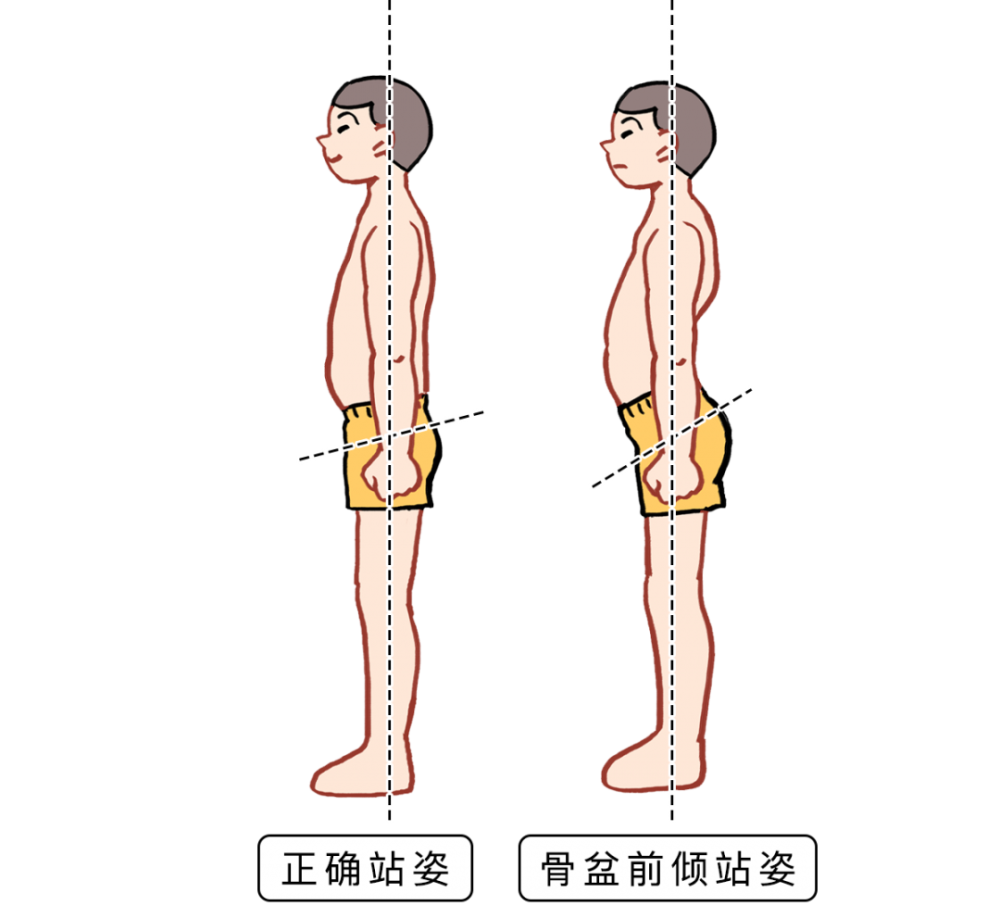 骨盆前倾是个啥可能有的人还不太了解那也不太对劲如果腰腾空很大一块