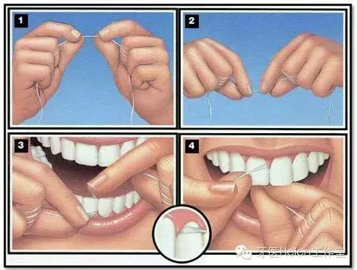 helen齿科中心——牙线的使用