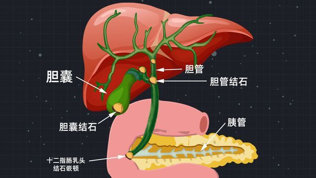 若胆囊结石要想排出必然经过胆囊管,当结石落入胆囊管并嵌顿至此,就会