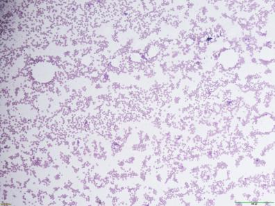 骨髓稀释标本一个隐藏的小偷