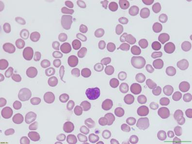 54%,coombs试验阴性,红细胞cd55百分比026,红细胞cd59百分比0
