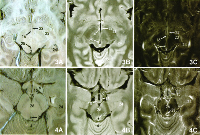 下丘腦核團的mri成像與斷層解剖對比_騰訊網
