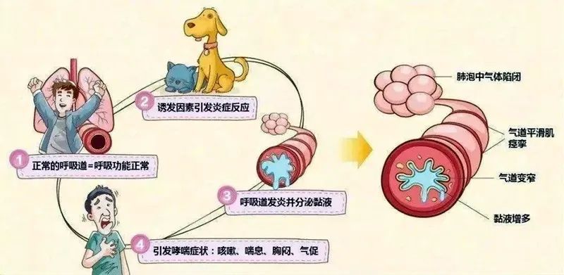 运动和病毒感染)后出现以下三类呼吸道症状:哮喘,全称支气管哮喘,是以