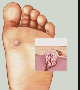 长春肤康皮肤科普跖疣和鸡眼的区别