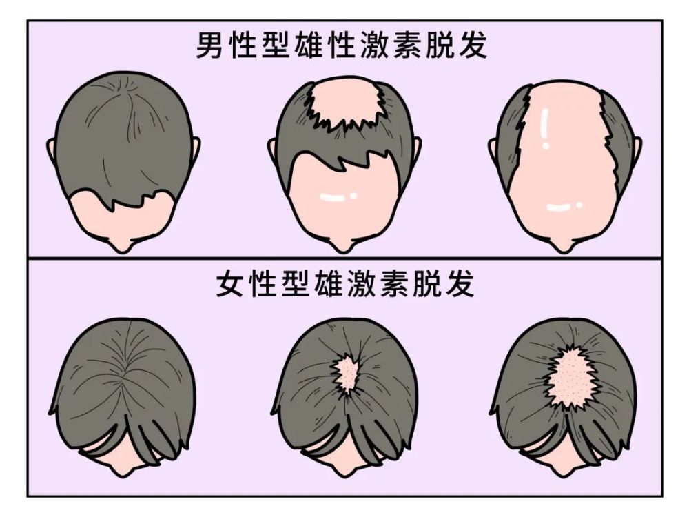 比较常见一种是激素性脱发,可以分为男性型雄性激素脱发和女性型雄